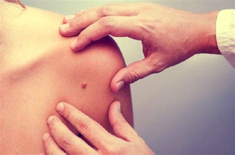 Some blood cancers start in the lymph nodes, like lymphomas. Regional Lymph-Node Surgery Does Not Improve Skin Cancer ...