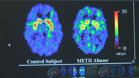 Expert Explains How Meth Can Affect Brain Keci