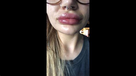 woman complains about botched lip fillers and is stunned by beauty salon s lewd response