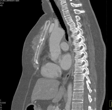 Lymphoma With Tumor Infiltration Of The Sternum Musculoskeletal Case