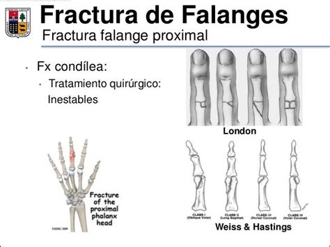 19 Seminario Fx Escafoides Mtc Y Falanges Df