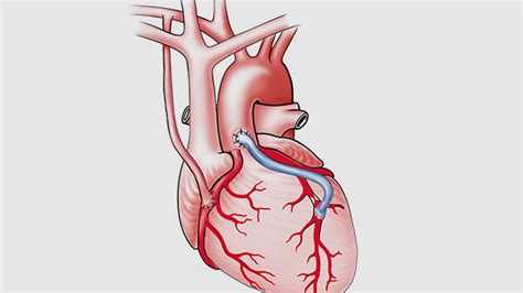 Faqs About Coronary Artery Bypass Surgery Articlesify