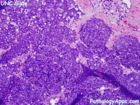 Merkel cell carcinoma is a highly aggressive primary cutaneous neuroendocrine carcinoma primarily affecting elderly and immunosuppressed individuals. Merkel Cell Histology - Histopathology Images Of Small ...