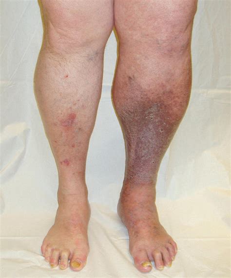 Deep Vein Thrombosis Symptoms Causes Treatment Pictures