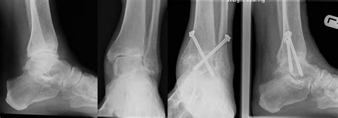 Ankle And Foot Fusion Surgery London Uk Rheumatoid Arthritis Hertfordshire