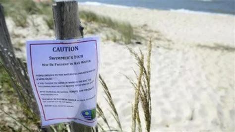 Swimmers Itch Parasite In Delaware Bay Burrows In Skin Causes Bumps