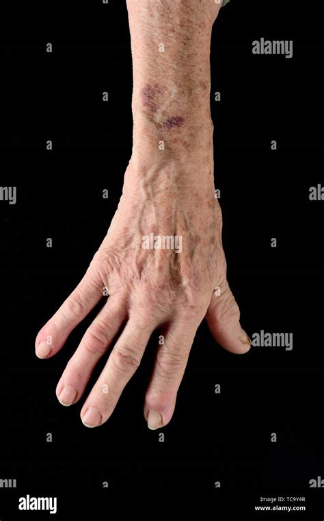 Bruise Arm High Resolution Stock Photography And Images Alamy