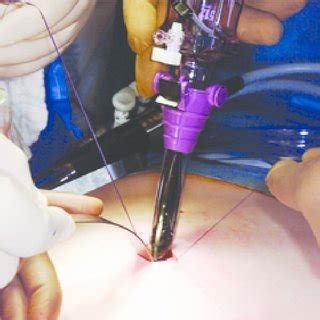 Pdf Robot Assisted Laparoscopic Radical Hysterectomy