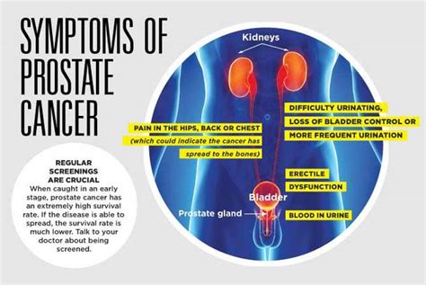 How To Know If Prostate Cancer Has Spread To The Bones Prostate