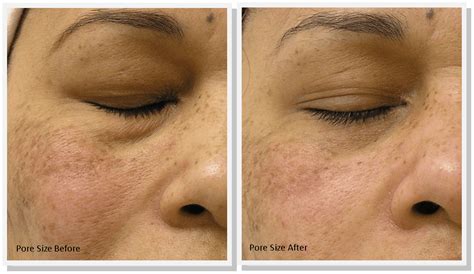 Does A Hydrafacial Really Remove Pigmentation Justinboey