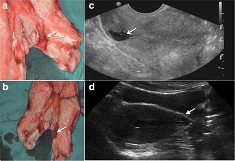 Obstetrical Outcomes After Vaginal Repair Of Caesarean Scar Diverticula In Reproductive Aged