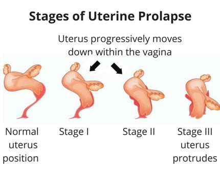 How To Avoid Your Uterine Prolapse Symptoms Worsening Pelvic Exercises