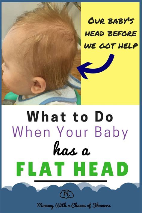 Fixing Our Sons Flat Head Syndrome Part 1 Flat Head Syndrome Flat