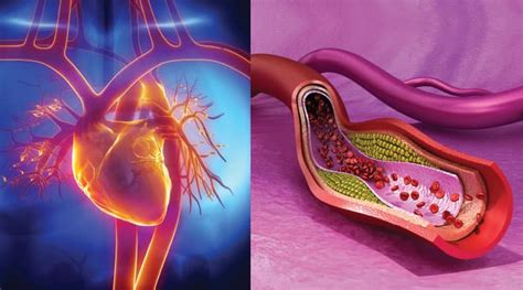 How To Prevent Arterial Plaque Ruptures Life Extension