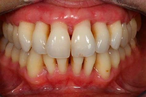 Advanced Periodontal Disease Pictures Perio Peak