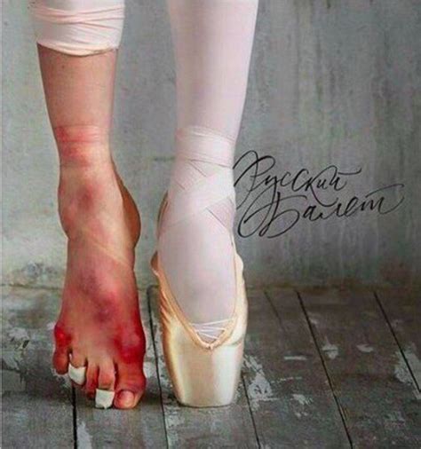 The Price You Pay For Being A Ballerina Ballet Pies De Bailarina