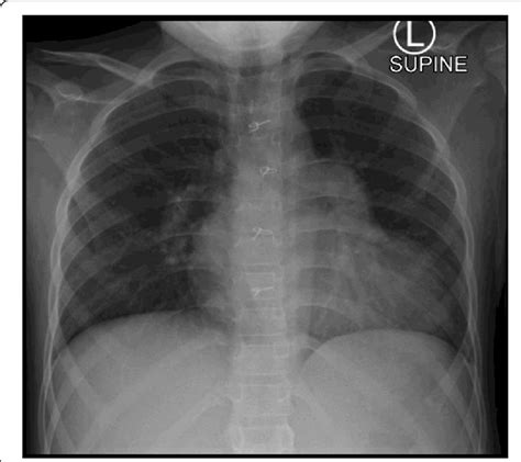 Chest X Ray Showing That The Cardiac Silhouette Is Enlarged With The