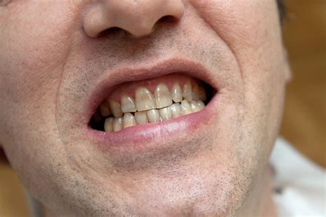 Tetracycline Teeth Stains Everything You Need To Know