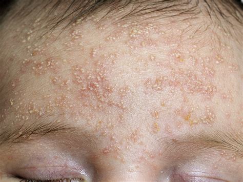 Skin Rash On Forehead Pictures