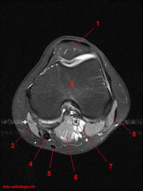If you think of the knee in layers, the deepest layer is bone and ligaments, then ligaments of the joint capsule, then muscles on top. Atlas of Knee MRI Anatomy - W-Radiology