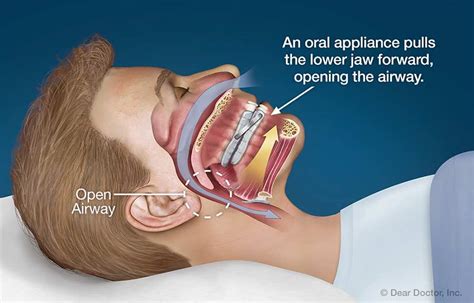 Snoring And Sleep Apnea Joseph Hudgins Orthodontics Carbondale Illinois