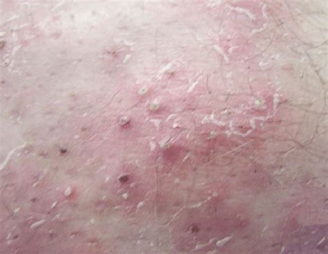 Folliculitis Photo Courtesy Of The Hc Ufpr Dermatology Service