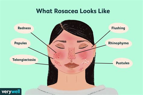 Living With Rosacea A Guide To Managing The Chronic Facial Skin