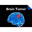 Brain Tumor Symptoms You Can Recognize Even Before Go To A Doctor