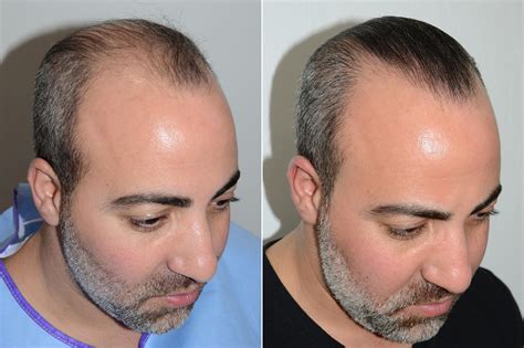 Hair Transplants For Men Pictures Miami Fl Paciente