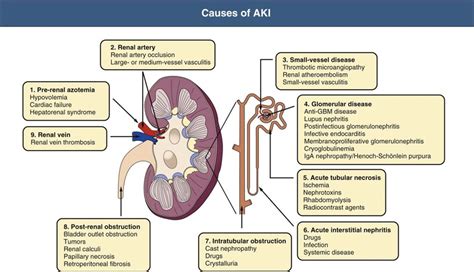 Pathophysiology And Etiology Of Acute Kidney Injury Abdominal Key