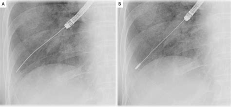 Radiographic Guidance For Selection Of Transbronchial Lung Cryobiopsy