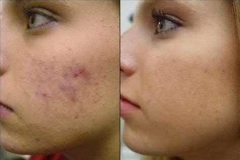 Pimple Inversa Also Known As Hidradenitis Suppurativa Info 2013