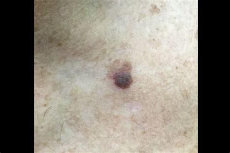 Derm Dx Itchy Lesion On The Chest Dermatology Advisor