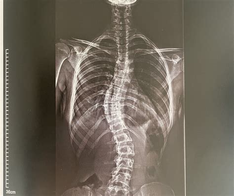 I Got My Spine Checked After Over A Decade And I Feel Quite