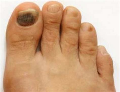 Bruised Toenail Causes Treatment How To Heal Remedies Updated