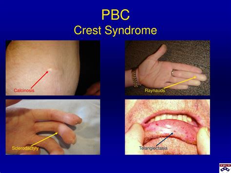 Ppt Primary Biliary Cirrhosis Pbc Powerpoint Presentation Free