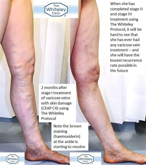 Recurrent Varicose Veins And Brown Stains At Ankle The Whiteley Clinic