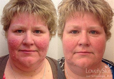 Omaha Dermatology Rosacea Treatments Skin Specialists Pc