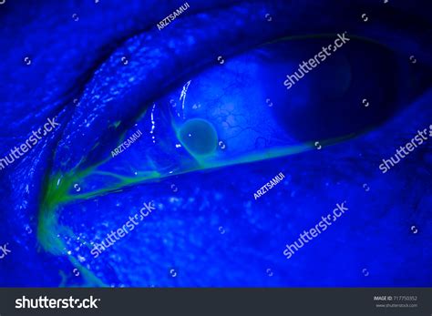 Close During Eye Examination Stock Photo 717750352 Shutterstock