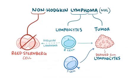 How To Diagnose Non Hodgkins Lymphoma Theatrecouple12