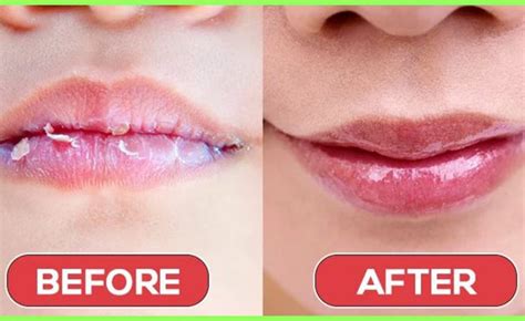 Home Remedies For Chapped Lips Indiapost Newspaper