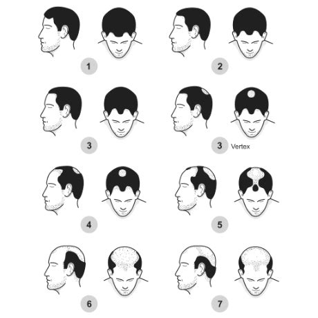 The 7 Stages Of Male Pattern Baldness Explained Skalp