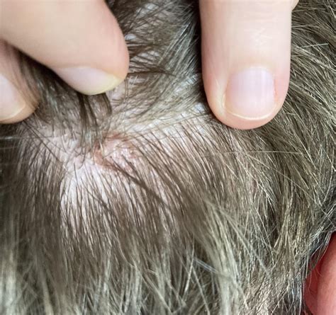 Strange Mole With Dark Ring Around It On Scalp Not Itchy And I