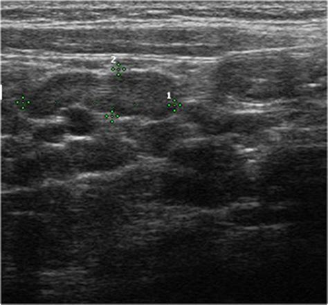 Ultrasound Features Of Appendicitis Other Findings Of Appendicitis