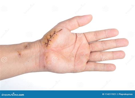 Suture Wound On Hand Isolate Stock Image Image Of Healing People