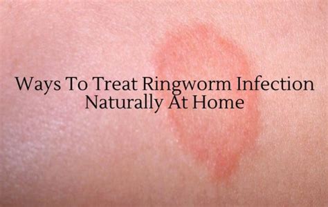 Ringworm Treatment Home Remedies How To Get Rid Of Ringworm