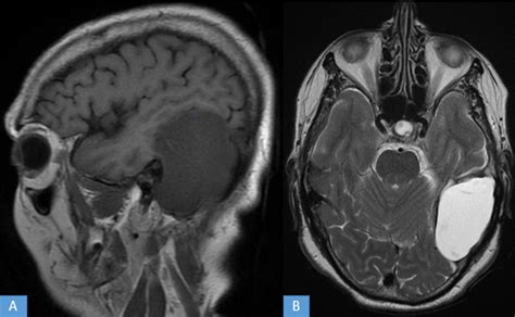 Unusual Location Of A Recurrent Epidermoid Cyst