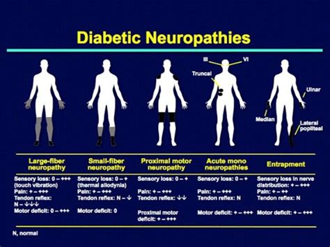 Diabetic Peripheral Neuropathy Types