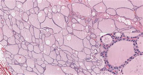Thyroid Normal Histology Nus Pathweb Nus Pathweb