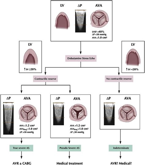 Severe Aortic Stenosis Echo